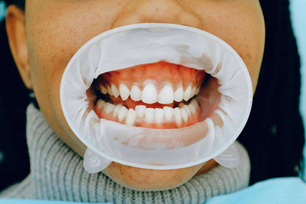 Detailed image of a woman's open mouth showing gums during a periodontal checkup.