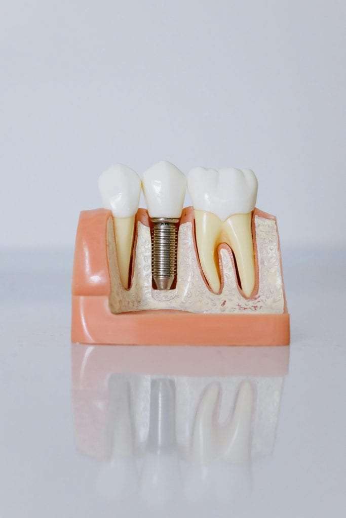 Detailed view of a dental implant model showcasing teeth and gum anatomy for patient education.