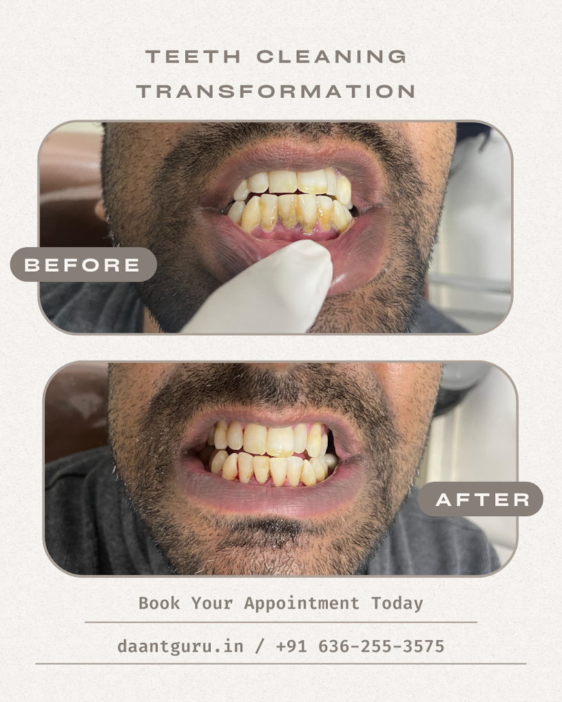 Zirconia Bridge. Before-After