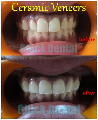 Ceramic Veneers