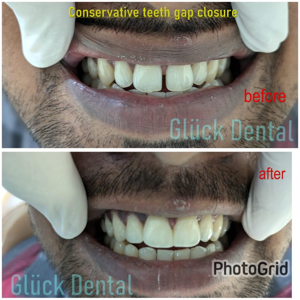 Conservative Dentistry Gap Closure Dental Bonding Before After
