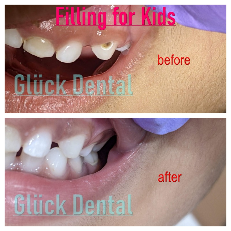 Teeth Filling for Kida Before after