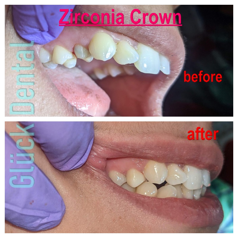 Zirconia Crown Before After