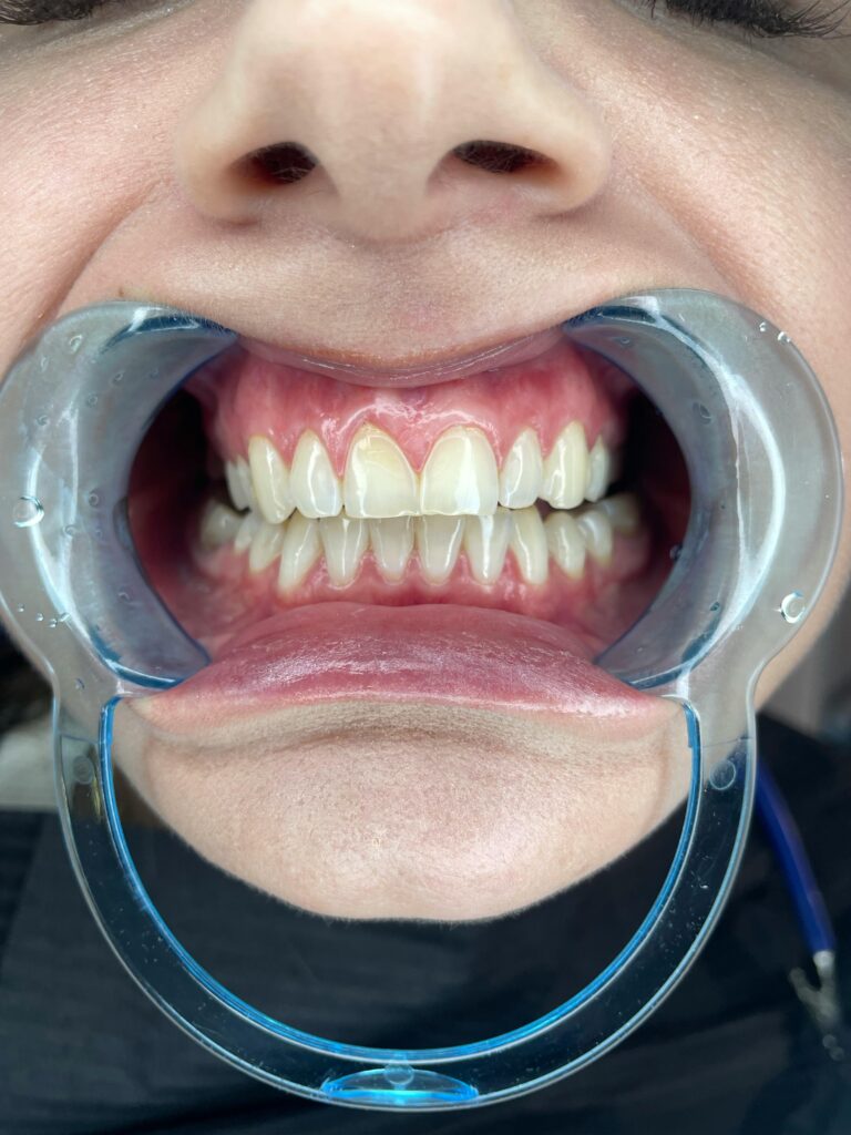 Detailed view of teeth during a dental checkup using a retractor device.